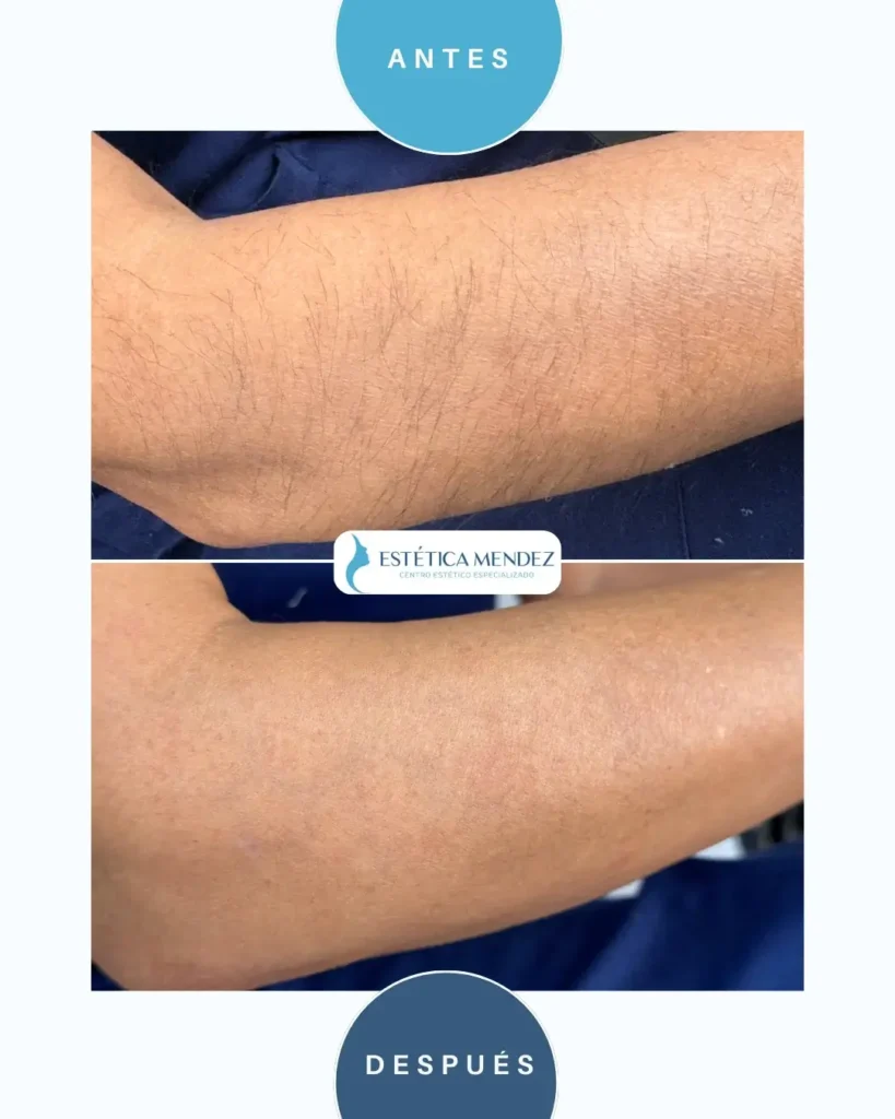 depilacion-laser-antes-despues-1