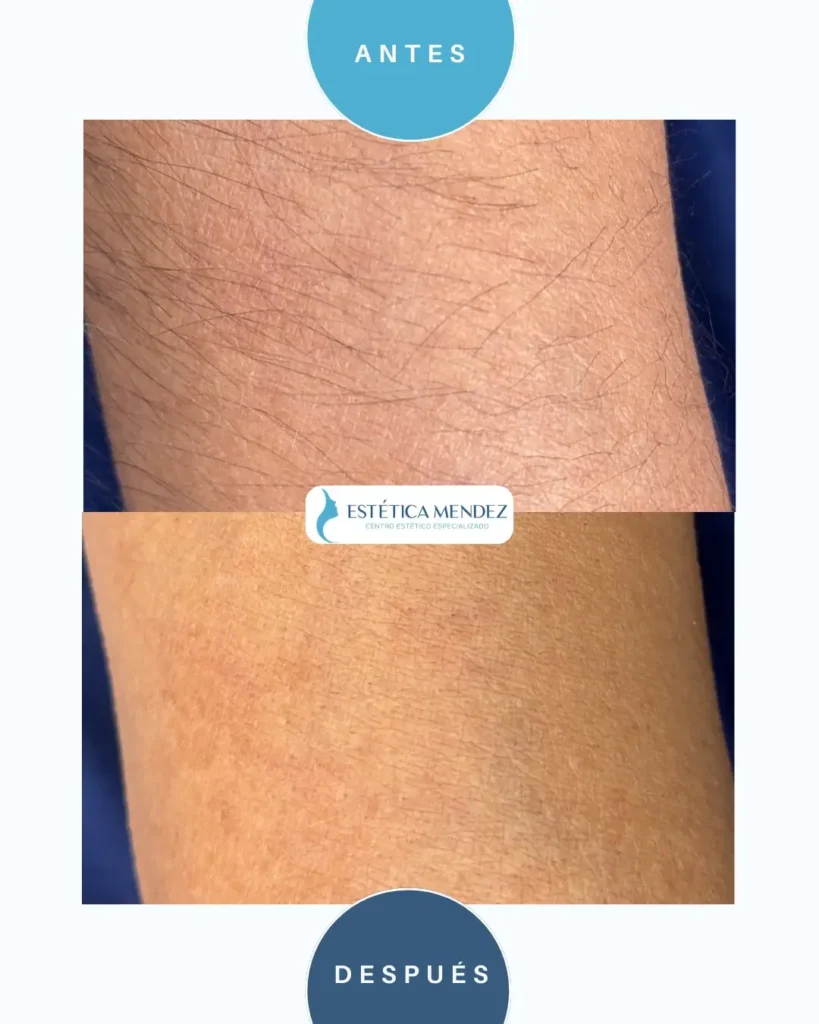 depilacion-laser-antes-despues-3